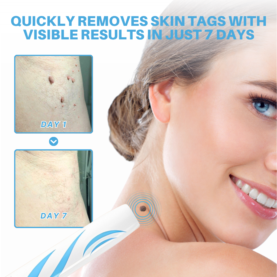 Painless At-home Skin Tag Removal Pen