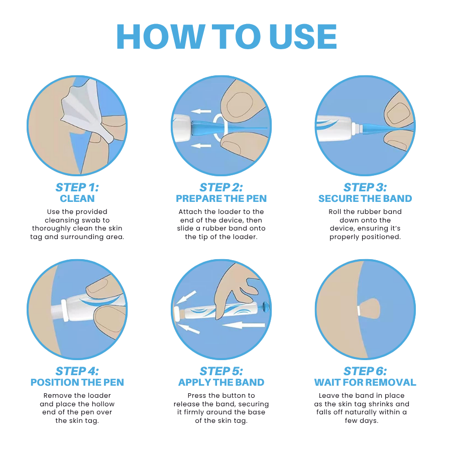 Painless At-home Skin Tag Removal Pen