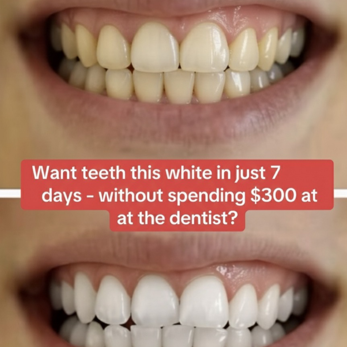 Whitening Strips 7 Day Smile Makeover
