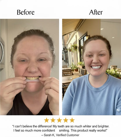 Whitening Strips 7 Day Smile Makeover
